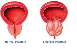 BPH normal verses swollen image and supplements for BHP