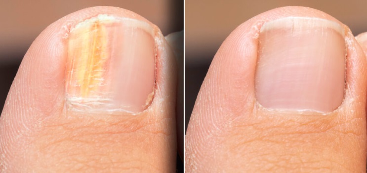 Toe Nail Fungus before and after